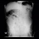 Pneumoperitonum after EPE, endoscopic polypectomy, complication, hemoclips: X-ray - Plain radiograph